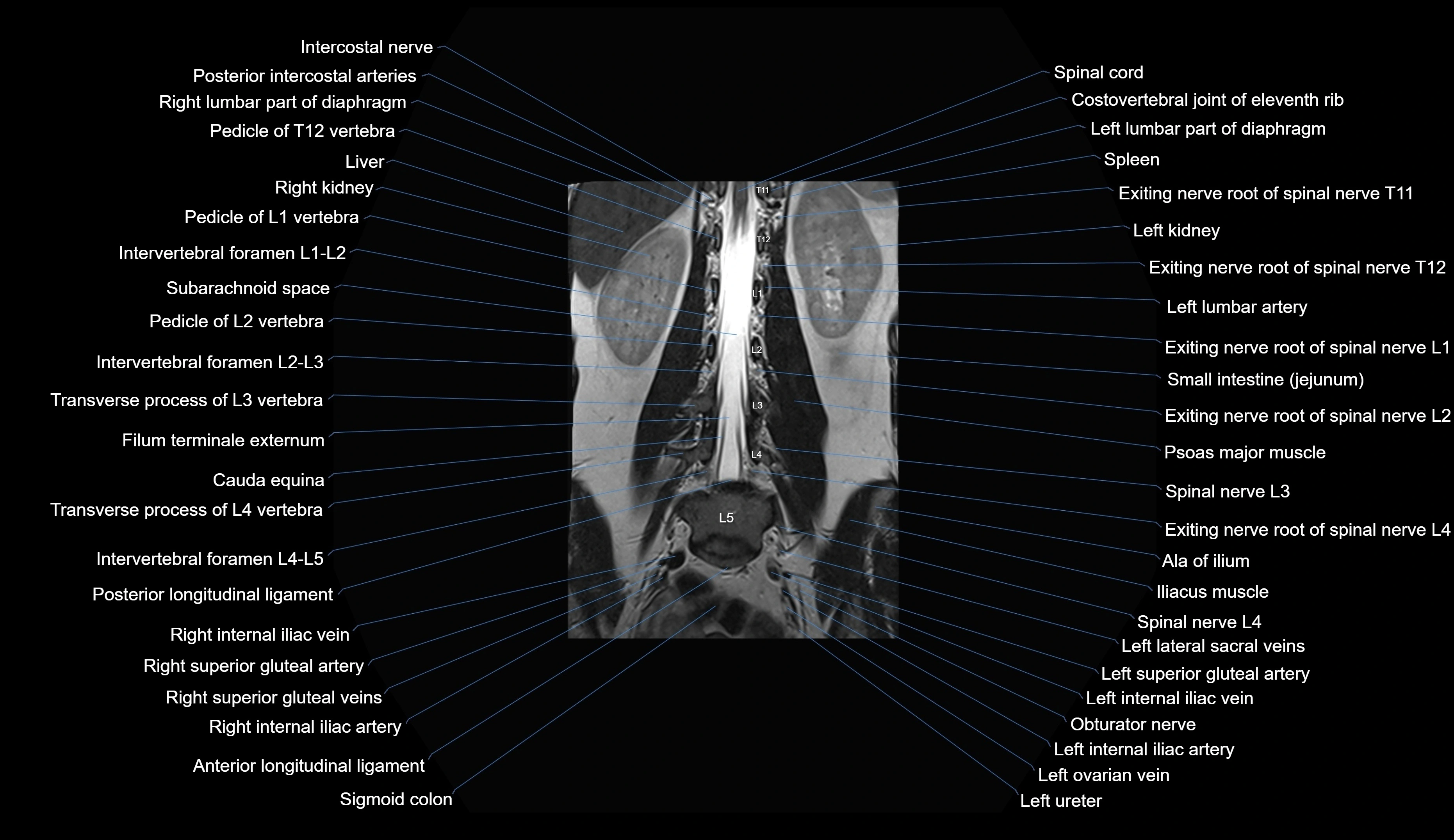 MRI lumbar spine coronal cross sectional anatomy 3T radiology  image-img-00001-00018.webp